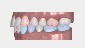 Occlusion and Clear Aligner Basics