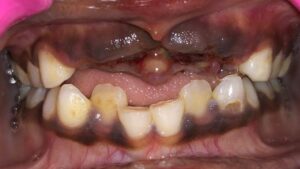 Dental Avulsion: Emergency Management and Clinical Care