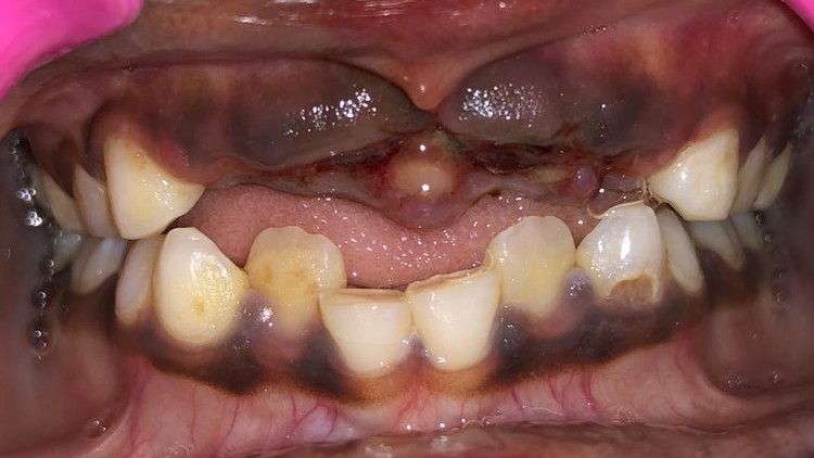 Dental Avulsion: Emergency Management and Clinical Care